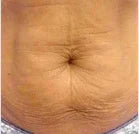 Reduce la flacidez - Before