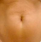 Reduce la flacidez - After