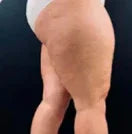 Moldea y reduce medidas - Before
