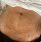 Disminuye visiblemente la apariencia de la celulitis - Before