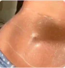 Disminuye visiblemente la apariencia de la celulitis - After